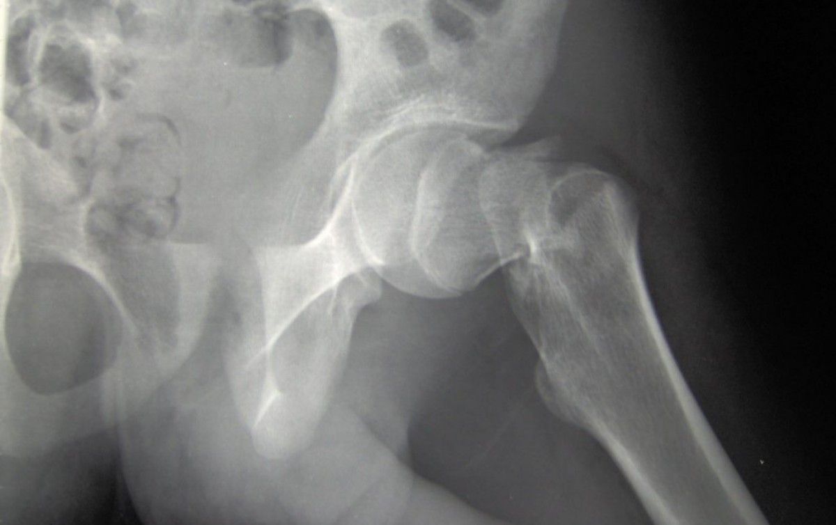 Radiografia d’un maluc, amb la part superior del femur fracturada 